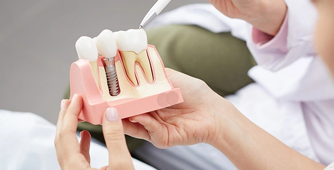 Dental Implants in San Juan Capistrano, CA